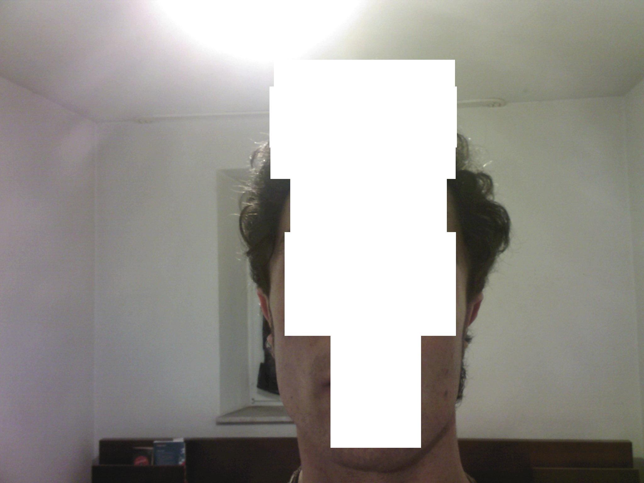 index.php/fa/4684/0/ich wurde auch in nürnberg operiert. nein zehnmal habe ich nicht vor mich operieren zu lassen.<br />
<br />
an HolyMoly123<br />
<br />
was hast du in nürnberg machen lassen standard ohren anlegung, oder polyethylen implantat ??<br />
<br />
ja es ist echt schade da hast du recht ??<br />
<br />
siehe bild. kommt gleich.<br />
<br />
